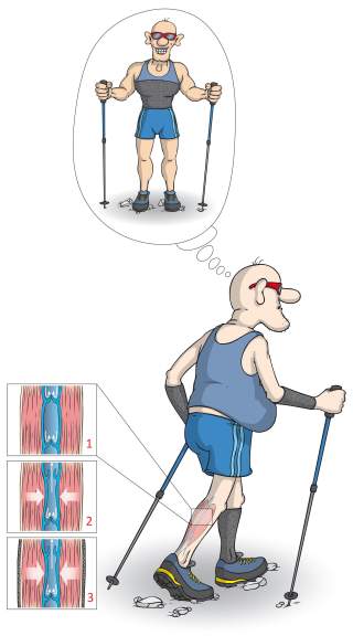 Illustration der Wirkung von Kompressionsstrümpfen